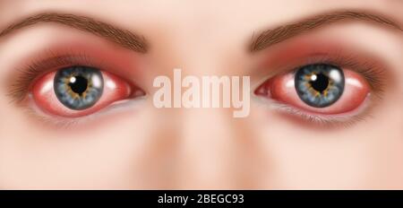 Illustration de la conjonctivite allergique. La conjonctivite est une inflammation de la conjonctive (membrane de couverture) de l'œil. Les symptômes sont causés par une réaction allergique de la conjonctive à une substance étrangère, les déclencheurs courants incluent le décomposition, la solution de lentilles de contact ou le pollen. Le traitement comprend éviter la cause, et les yeux antihistaminiques pour soulager les symptômes. Banque D'Images
