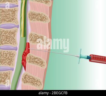 Procédure épidurale de patch de sang, Illustration Banque D'Images