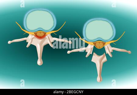 Une laminectomie due à des expectores osseuses. Cette procédure médicale soulage la pression sur la moelle épinière. Banque D'Images