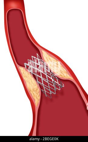 Angioplastie avec stenting, 3 sur 4 Banque D'Images