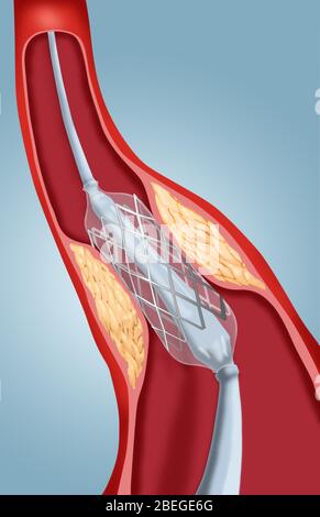 Angioplastie avec stenting, 2 sur 4 Banque D'Images