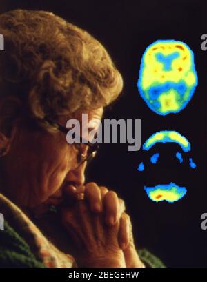La maladie d'Alzheimer Banque D'Images