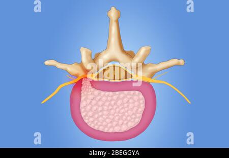 Vertèbre lombaire et disque hernié Banque D'Images