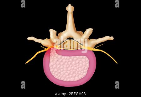Vertèbre lombaire et disque hernié Banque D'Images