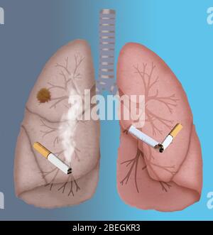 Poumons sains et cancéreux Banque D'Images