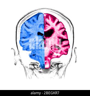 Comparaison normale / cerveau d'Alzheimer Banque D'Images