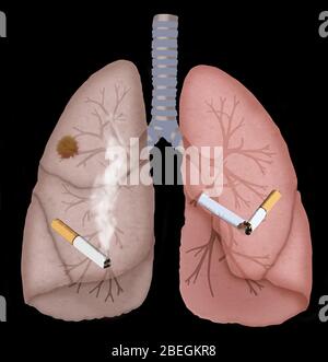 Poumons sains et cancéreux Banque D'Images
