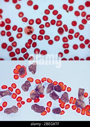 Comparaison sang santé/leucémie Banque D'Images