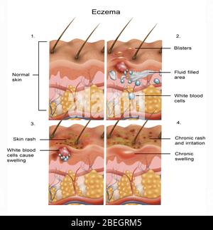 Eczéma Banque D'Images