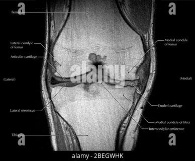 Arthrite du genou, IRM Banque D'Images