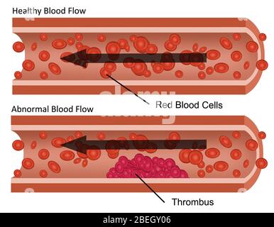 Débit sanguin sain et anormal Banque D'Images