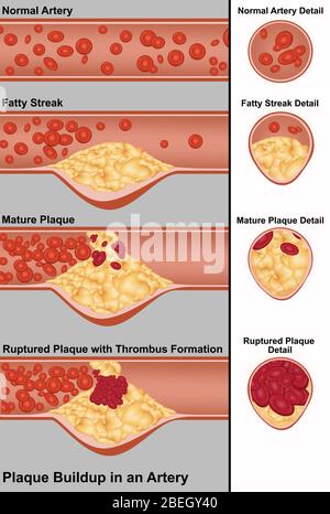 Plaque dans l'artère Banque D'Images
