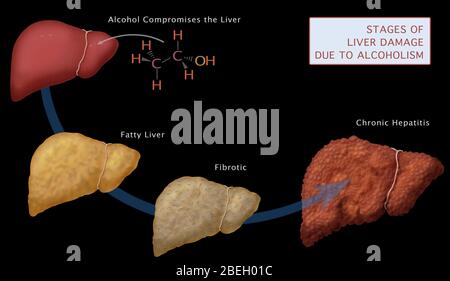 Stades de dommages au foie Banque D'Images