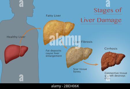 Stades de dommages au foie Banque D'Images
