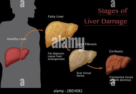 Stades de dommages au foie Banque D'Images