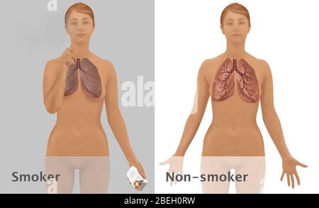 Poumons de fumeur contre non fumeur Banque D'Images