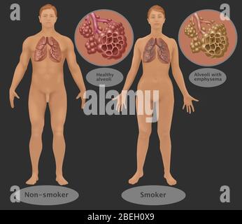 Poumons et alvéoles de fumeur contre non fumeur Banque D'Images