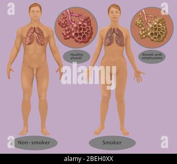 Poumons et alvéoles de fumeur contre non fumeur Banque D'Images
