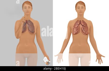 Poumons de fumeur contre non fumeur Banque D'Images