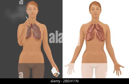 Poumons de fumeur contre non fumeur Banque D'Images