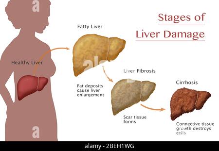 Stades de dommages au foie Banque D'Images