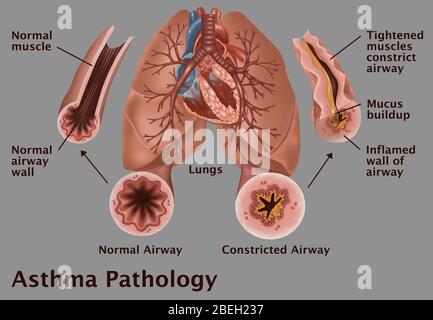 Pathologie de l'asthme Banque D'Images
