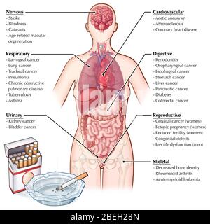 Effets du tabagisme Banque D'Images