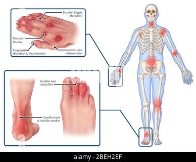 Symptômes de l'arthrite rhumatismatique Banque D'Images