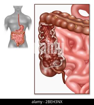 Maladie de Crohn, DCI, Illustration Banque D'Images
