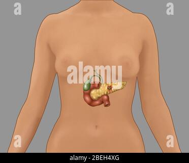 Illustration du cancer du pancréas encart dans un contour d'une figure féminine. Au centre du pancréas se trouve la tumeur (zone brune). La vésicule biliaire (verte) et le duodénum (rouge brûlé) sont également présents. Banque D'Images