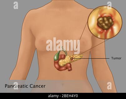 Cancer du pancréas chez les femmes Figure, Illustration Banque D'Images