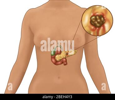 Cancer du pancréas chez les femmes Figure, Illustration Banque D'Images