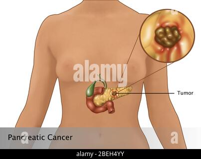 Cancer du pancréas chez les femmes Figure, Illustration Banque D'Images