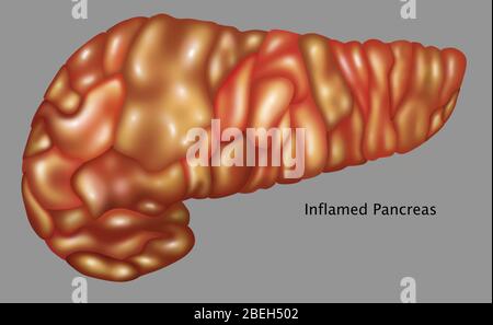 Pancréas enflammé, illustration Banque D'Images