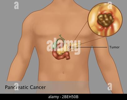 Illustration de cancer du pancréas L'encart dans un canevas d'une figure masculine. Au centre du pancréas est la tumeur (Brown). Sont également présents la vésicule (vert) et du duodénum (Burnt red). Banque D'Images