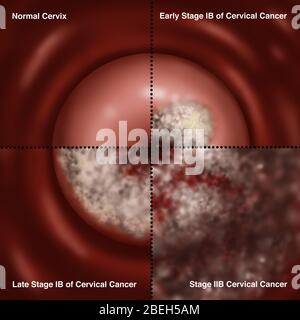 Progression du cancer du col de l'utérus, illustration Banque D'Images