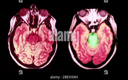 IRM du gliome cérébral et du tronc cérébral normal Banque D'Images