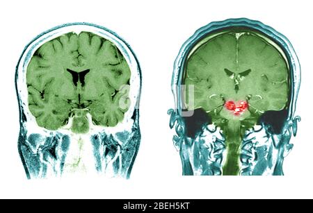 IRM des malformations cérébrales et du tronc cérébral normales Banque D'Images