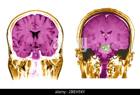 Sur la gauche se trouve une image IRM transversale frontale (vue frontale) frontale normale du cerveau à travers les lobes frontaux et les deux lobes temporels. À ce niveau, vous voyez deux cavités remplies de matière sombre près du centre de l'image. Ce sont les ventricules latéraux qui sont remplis de liquide rachidien cérébral (CSF). Il existe deux principaux types de tissu cérébral, la matière grise (qui contient les corps neuronaux et est plus foncée du tissu cérébral montré) et la matière blanche (qui est composée de fibres axones). Sur la droite se trouve une image IRM transversale frontale de la tête montrant le caveer Banque D'Images