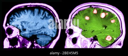 IRM des cerveaux, normal et avec tumeurs malignes Banque D'Images
