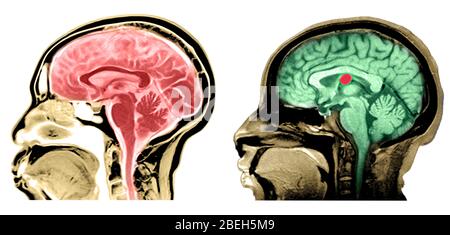 IRM du kyste normal du cerveau et du colloïde Banque D'Images