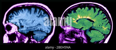 IRM des lésions cérébrales normales et de la sclérose en plaques Banque D'Images