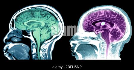 IRM du kyste normal du cerveau et du colloïde Banque D'Images