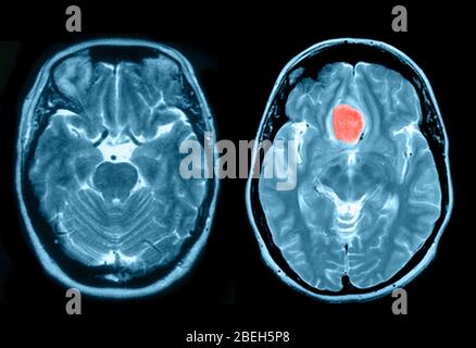 Cerveau normal et méningiome Banque D'Images