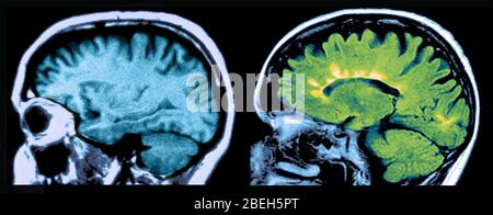 IRM des lésions cérébrales normales et de la sclérose en plaques Banque D'Images