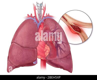 Embolisme pulmonaire, illustration Banque D'Images