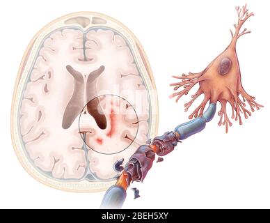 Illustration de la sclérose en plaques, maladie auto-immune qui endommage le système nerveux central, entraînant une variété de symptômes, dont des spasmes musculaires, une perte d'équilibre et de coordination, un engourdissement et une faiblesse musculaire. Dans la sclérose en plaques, la gaine de myéline qui protège l'axone d'un neurone est attaquée par le système immunitaire, en raison de ce qui est considéré comme un virus ou un gène défectueux. Lorsque cette couche de protection est endommagée, les signaux nerveux ralentissent ou s'arrêtent. Cette illustration montre un effet neurone par la maladie, ainsi qu'une vue transversale du cerveau au format cicatrices et plaque Banque D'Images