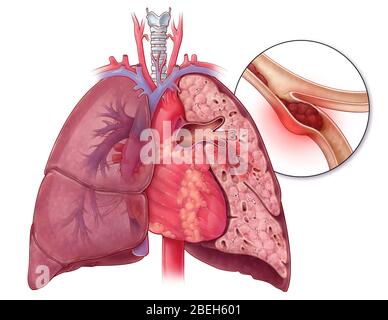 Embolisme pulmonaire, illustration Banque D'Images