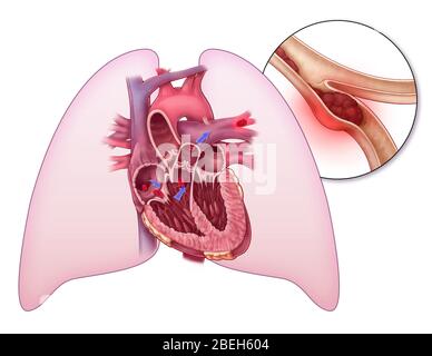 Embolisme pulmonaire, illustration Banque D'Images