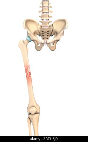 Illustration d'une fracture de la comminée dans laquelle l'os a brisé en plusieurs morceaux. Banque D'Images